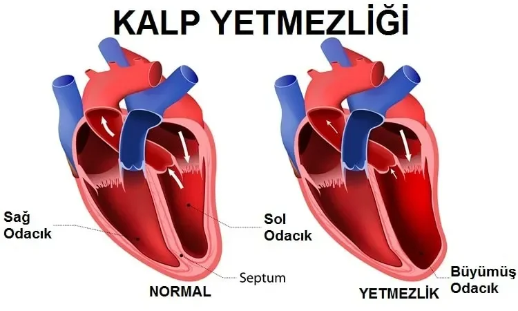 Kalp Yetmezliği Tedavisi: 10 Aylık Bebek Ankara'ya Sevk Edildi