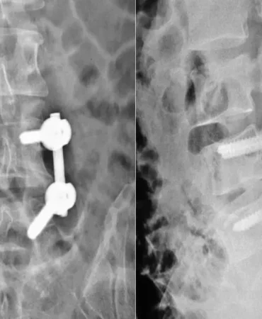 Patnosta Lomber Stabilizasyon Ameliyatı ile Sağlık Patnos Haberleri Ağrı Patnos Son Dakika Haberleri Patnosta Lomber Stabilizasyon Ameliyatı ile Sağlık
